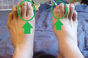 My overlapping toes without Pedifix's Visco-GEL Toe Spacers inserted.